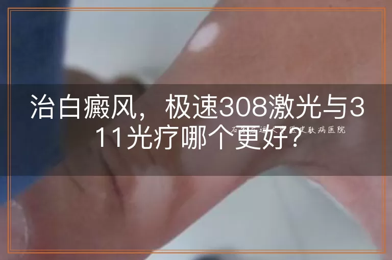 治白癜风，极速308激光与311光疗哪个更好？