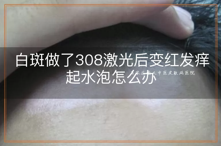 白斑做了308激光后变红发痒起水泡怎么办