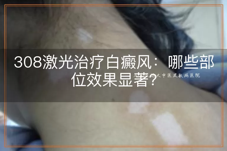 308激光治疗白癜风：哪些部位效果显著？