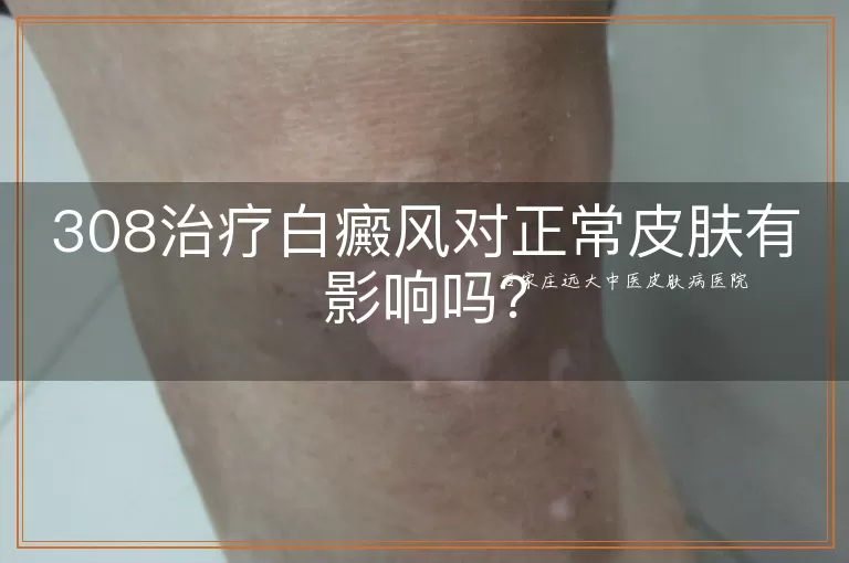 308治疗白癜风对正常皮肤有影响吗？