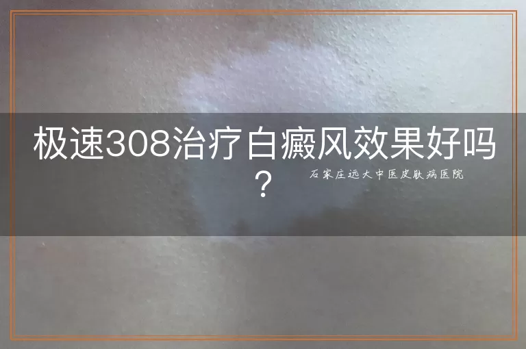 极速308治疗白癜风效果好吗？