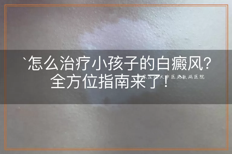 怎么治疗小孩子的白癜风？全方位指南来了！