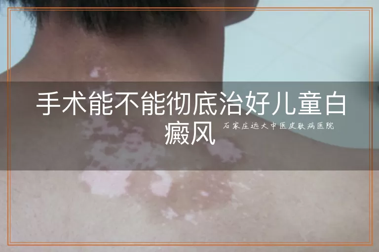 手术能不能彻底治好儿童白癜风