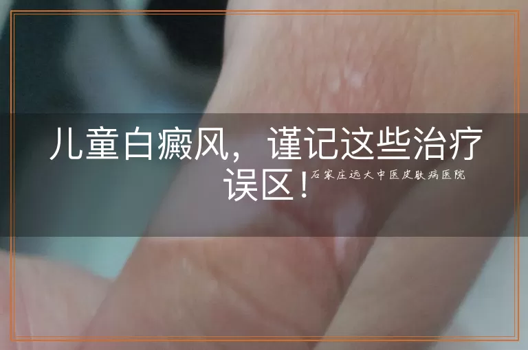 儿童白癜风，谨记这些治疗误区！