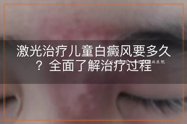 激光治疗儿童白癜风要多久？全面了解治疗过程