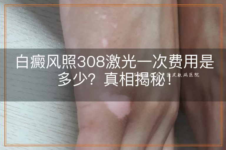 白癜风照308激光一次费用是多少？真相揭秘！
