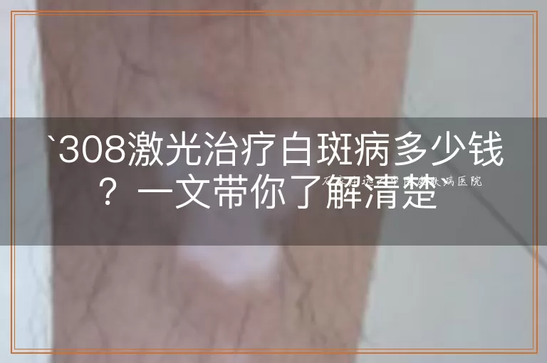308激光治疗白斑病多少钱？一文带你了解清楚