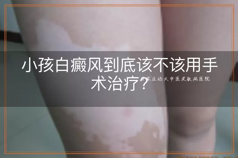 小孩白癜风到底该不该用手术治疗？