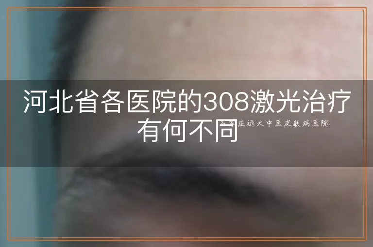 河北省各医院的308激光治疗有何不同