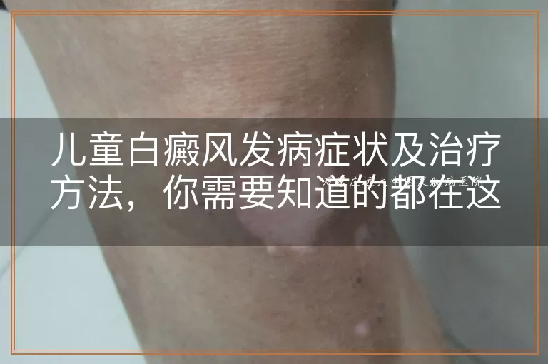儿童白癜风发病症状及治疗方法，你需要知道的都在这里！