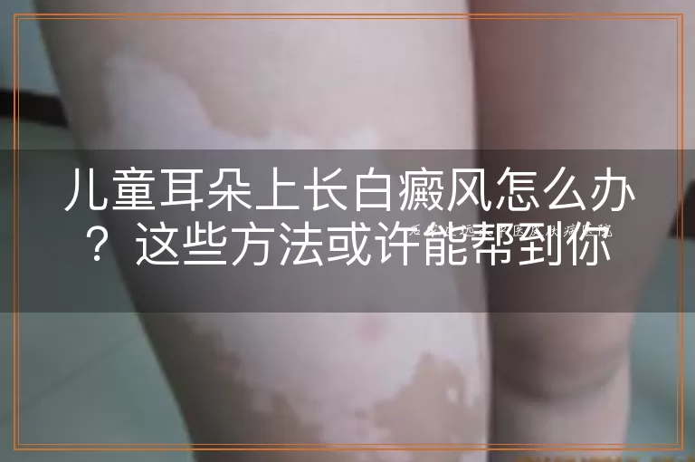 儿童耳朵上长白癜风怎么办？这些方法或许能帮到你