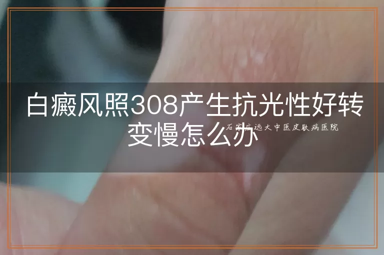 白癜风照308产生抗光性好转变慢怎么办