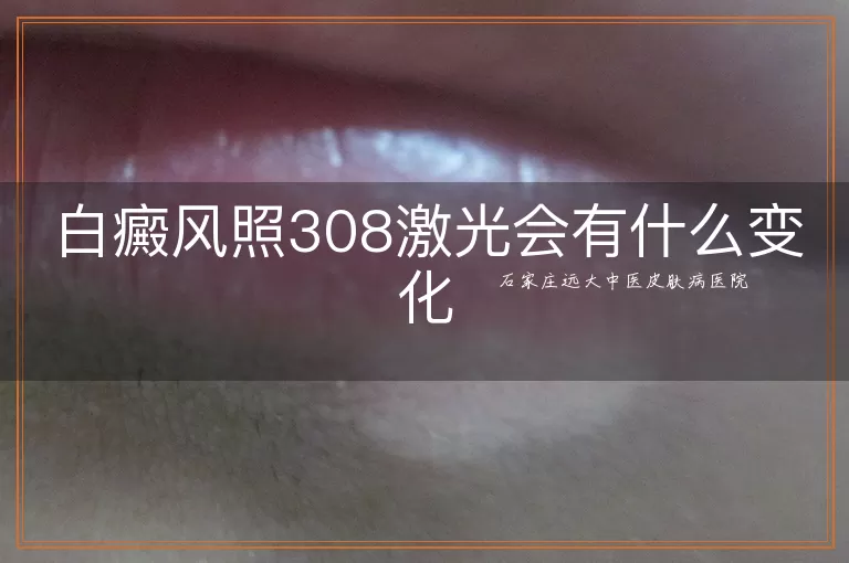 白癜风照308激光会有什么变化
