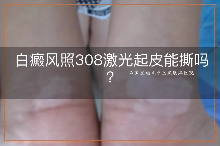 白癜风照308激光起皮能撕吗？