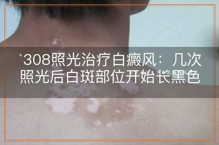 308照光治疗白癜风：几次照光后白斑部位开始长黑色素？