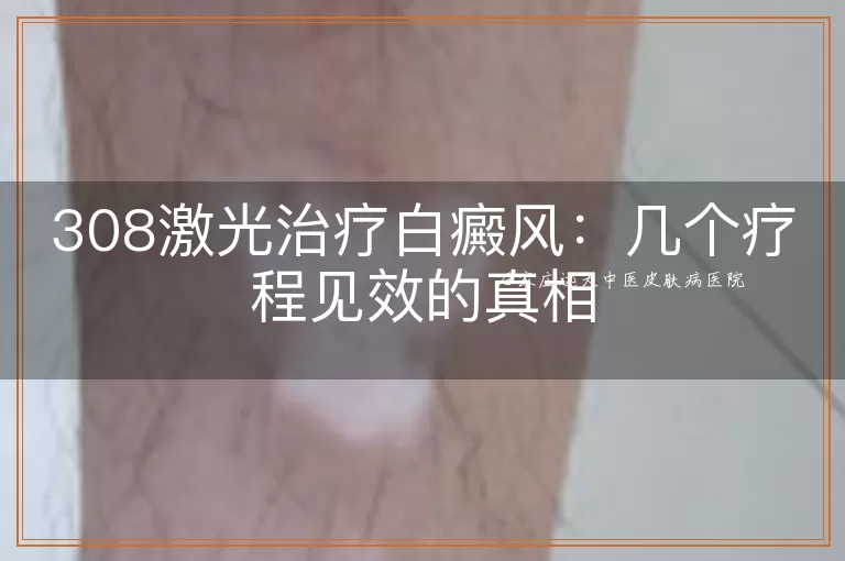 308激光治疗白癜风：几个疗程见效的真相