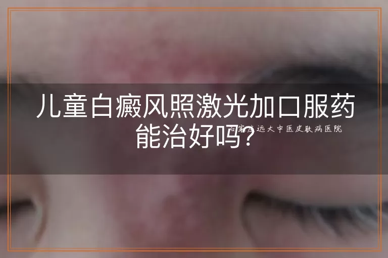 儿童白癜风照激光加口服药能治好吗？