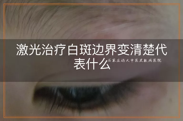 激光治疗白斑边界变清楚代表什么