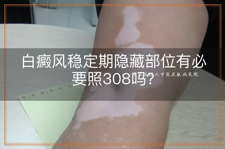 白癜风稳定期隐藏部位有必要照308吗？