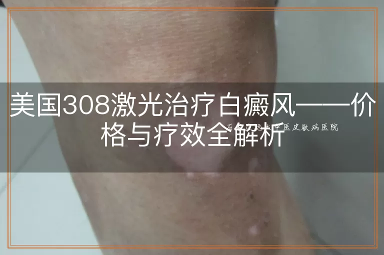 美国308激光治疗白癜风——价格与疗效全解析