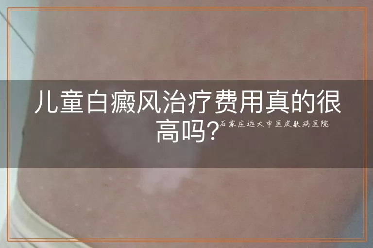儿童白癜风治疗费用真的很高吗？