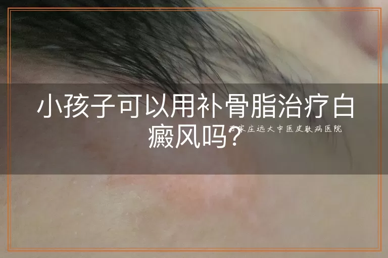 小孩子可以用补骨脂治疗白癜风吗？