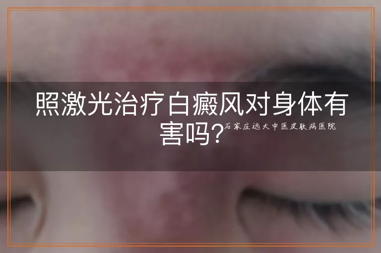 照激光治疗白癜风对身体有害吗？