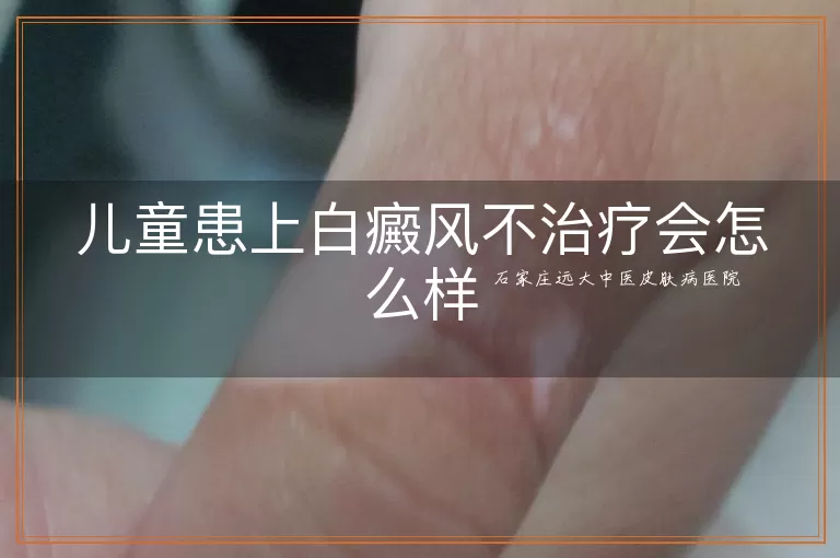 儿童患上白癜风不治疗会怎么样