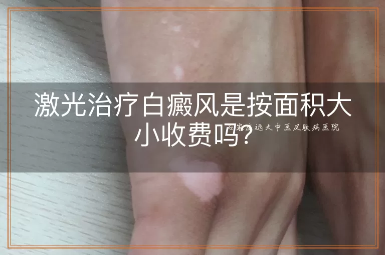 激光治疗白癜风是按面积大小收费吗？