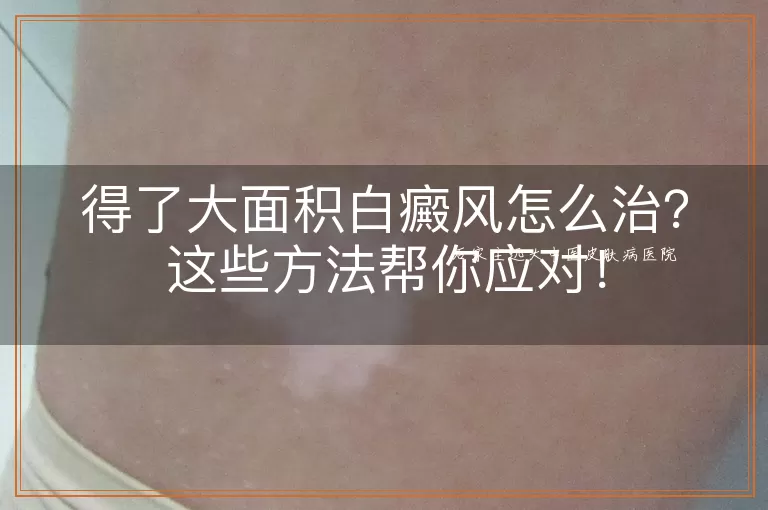 得了大面积白癜风怎么治？这些方法帮你应对！