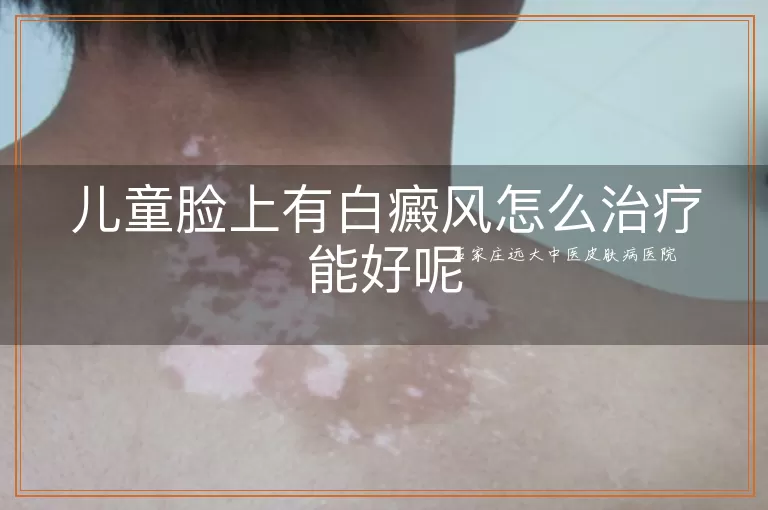 儿童脸上有白癜风怎么治疗能好呢