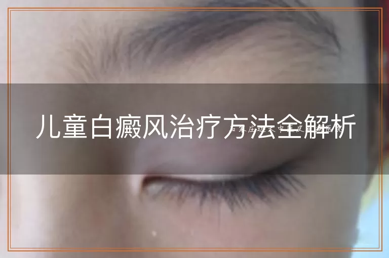 儿童白癜风治疗方法全解析