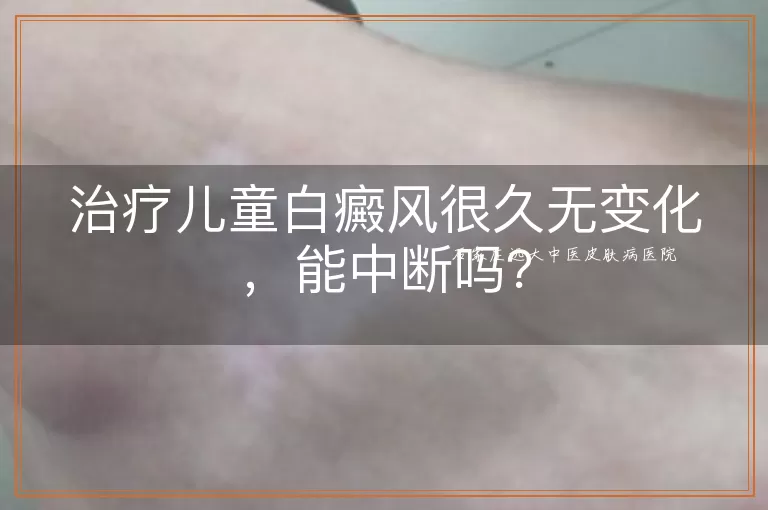 治疗儿童白癜风很久无变化，能中断吗？
