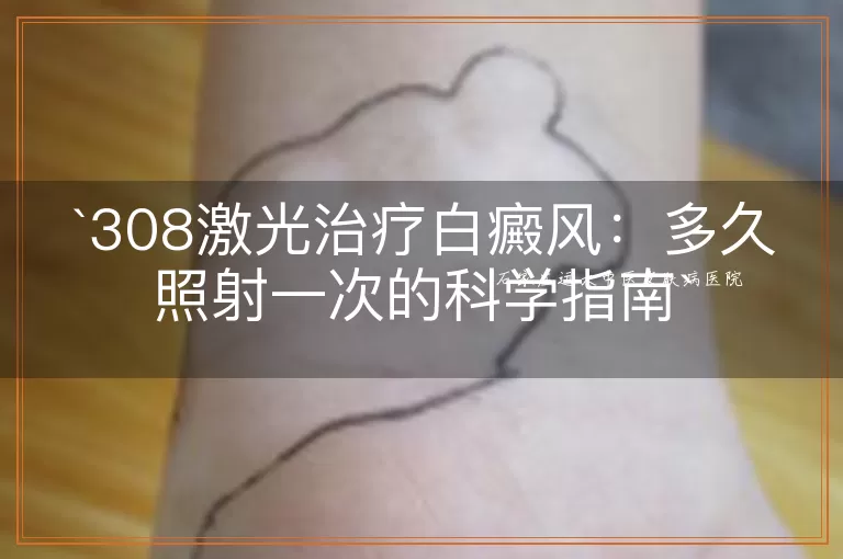 308激光治疗白癜风：多久照射一次的科学指南