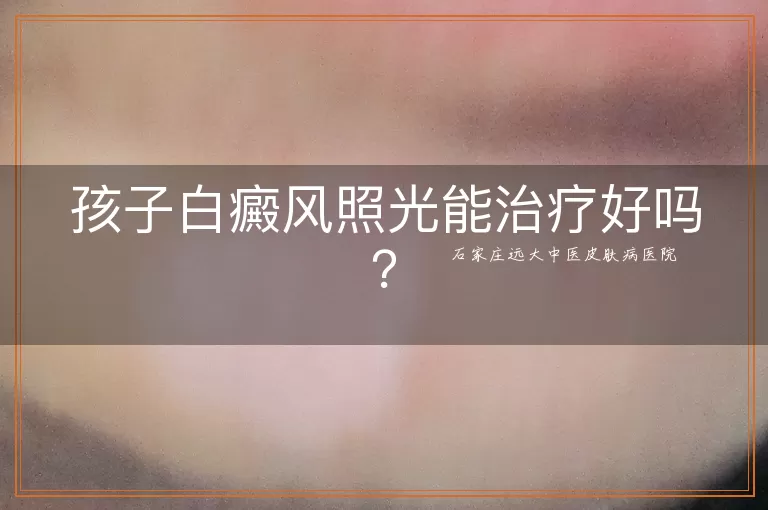 孩子白癜风照光能治疗好吗？