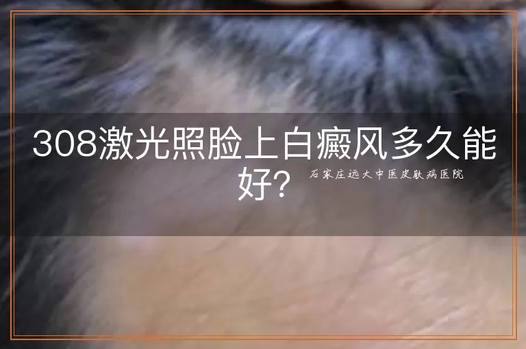 308激光照脸上白癜风多久能好？