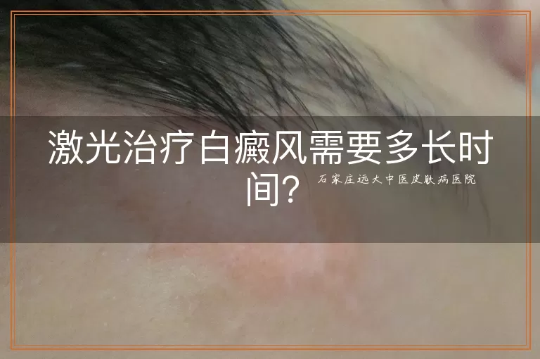 激光治疗白癜风需要多长时间？