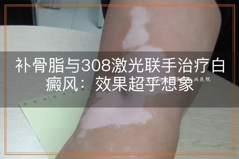 补骨脂与308激光联手治疗白癜风：效果超乎想象