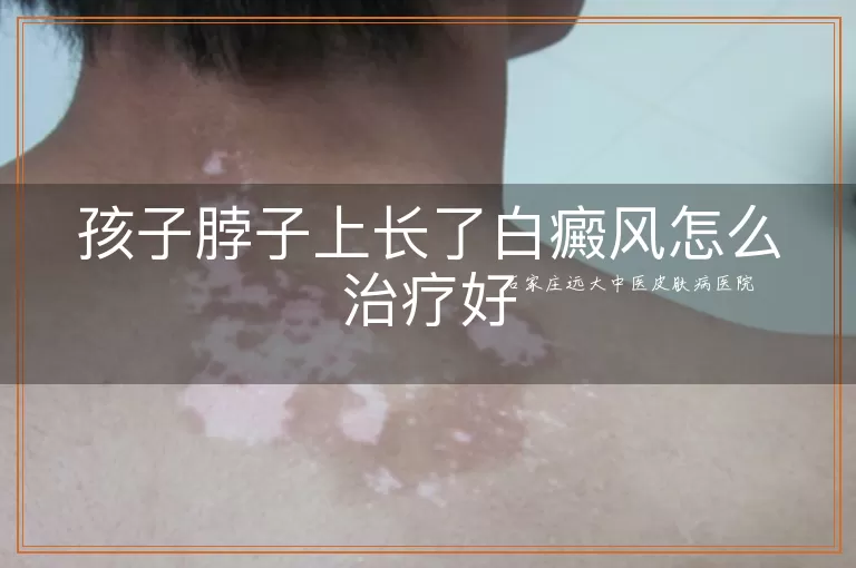 孩子脖子上长了白癜风怎么治疗好