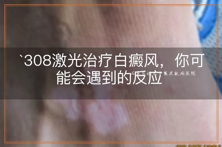 308激光治疗白癜风，你可能会遇到的反应