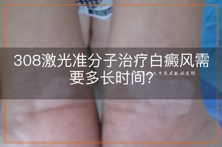 308激光准分子治疗白癜风需要多长时间？