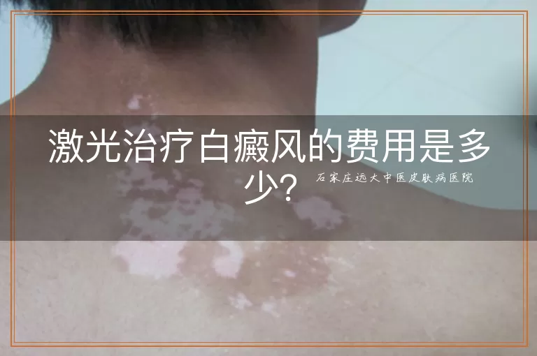 激光治疗白癜风的费用是多少？