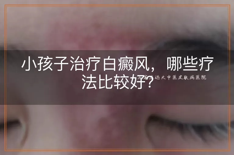 小孩子治疗白癜风，哪些疗法比较好？