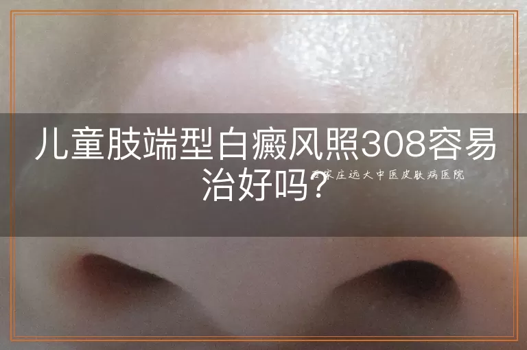 儿童肢端型白癜风照308容易治好吗？