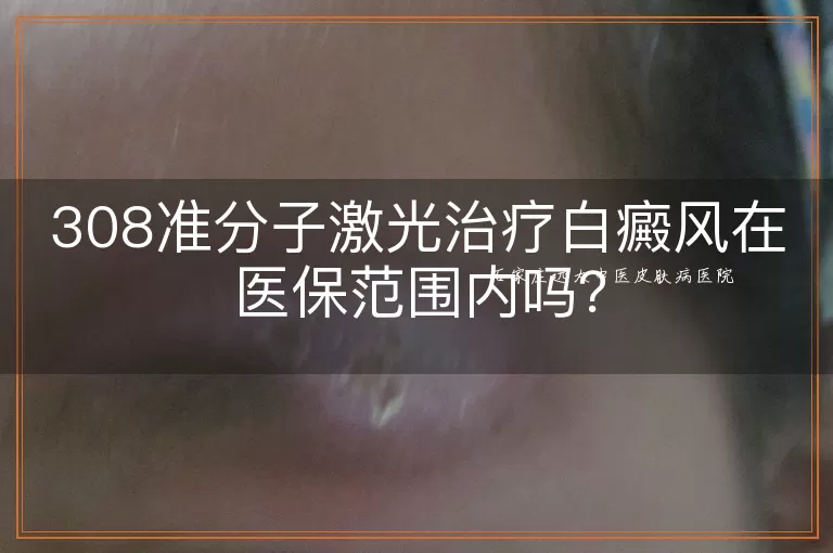 308准分子激光治疗白癜风在医保范围内吗？