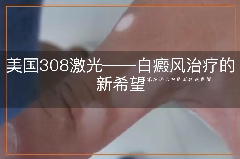 美国308激光——白癜风治疗的新希望