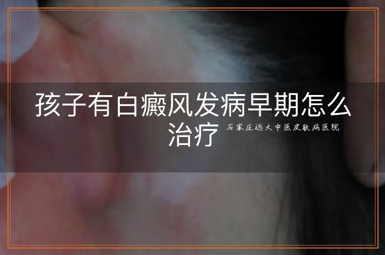 孩子有白癜风发病早期怎么治疗