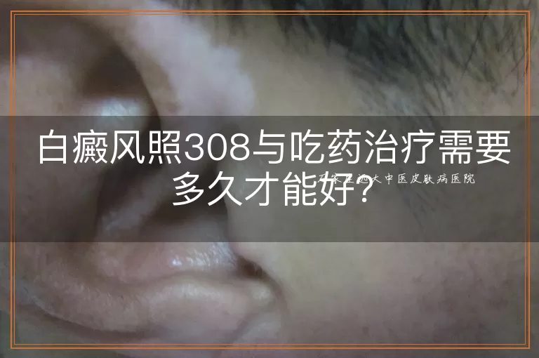 白癜风照308与吃药治疗需要多久才能好？
