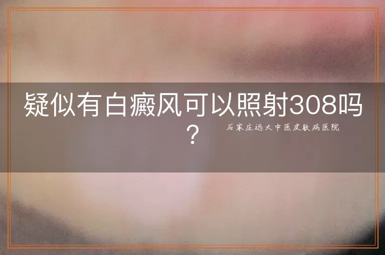 疑似有白癜风可以照射308吗？