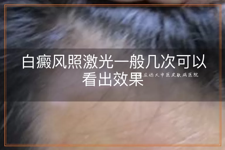 白癜风照激光一般几次可以看出效果